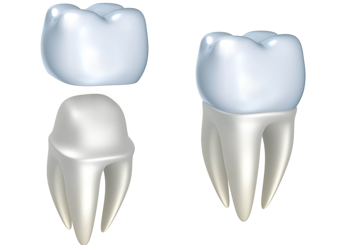 Crowns for Teeth in Novi MI Area