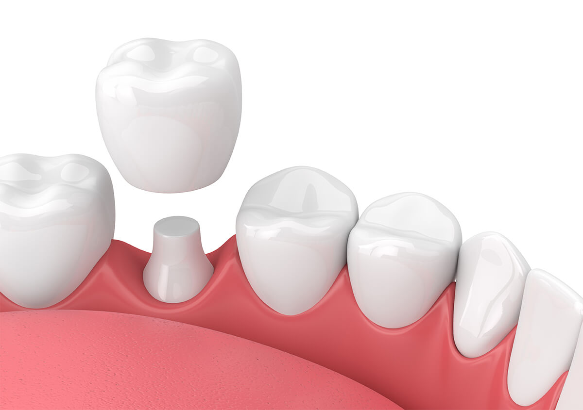 Porcelain Dental Crowns in Novi MI Area