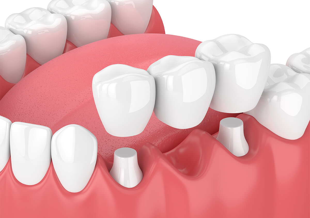 Dental Bridges Benefits in Novi Area