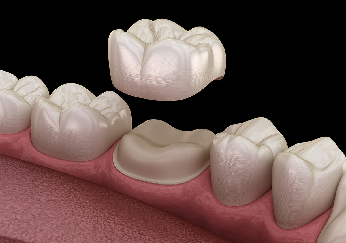 Dental Crowns for Teeth in Novi MI Area