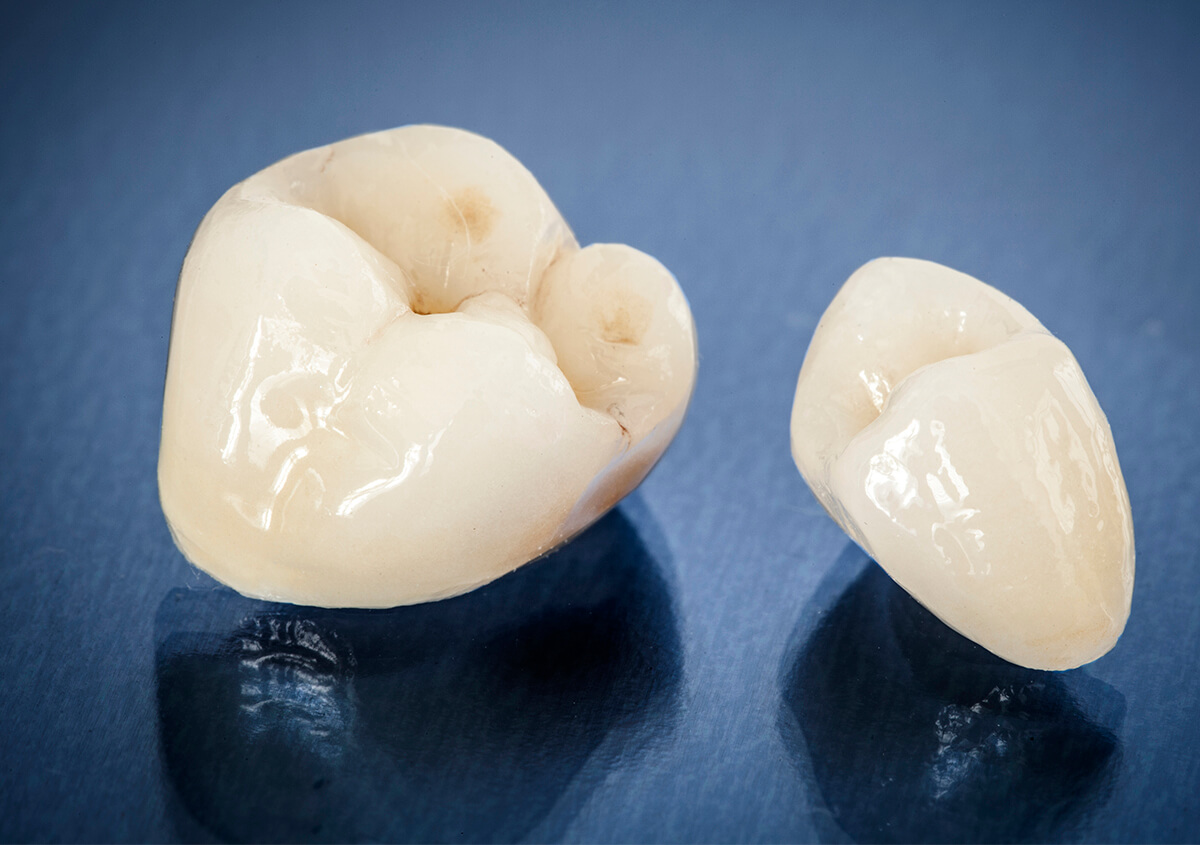 Dental Crowns on Front Teeth in Novi MI Area